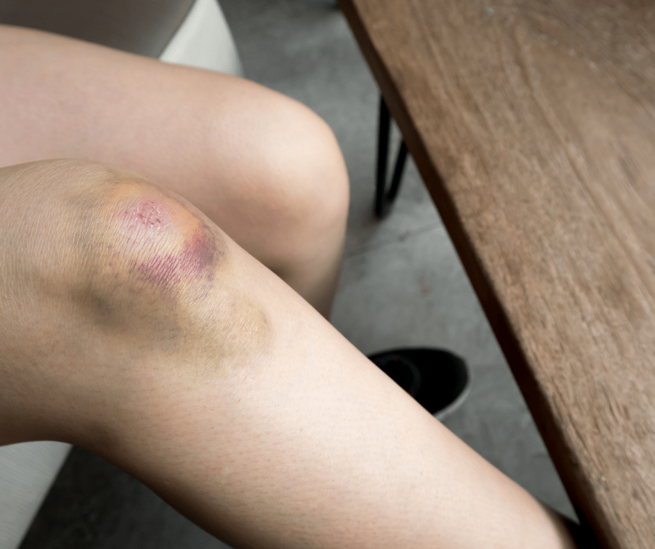 Bruise on knee